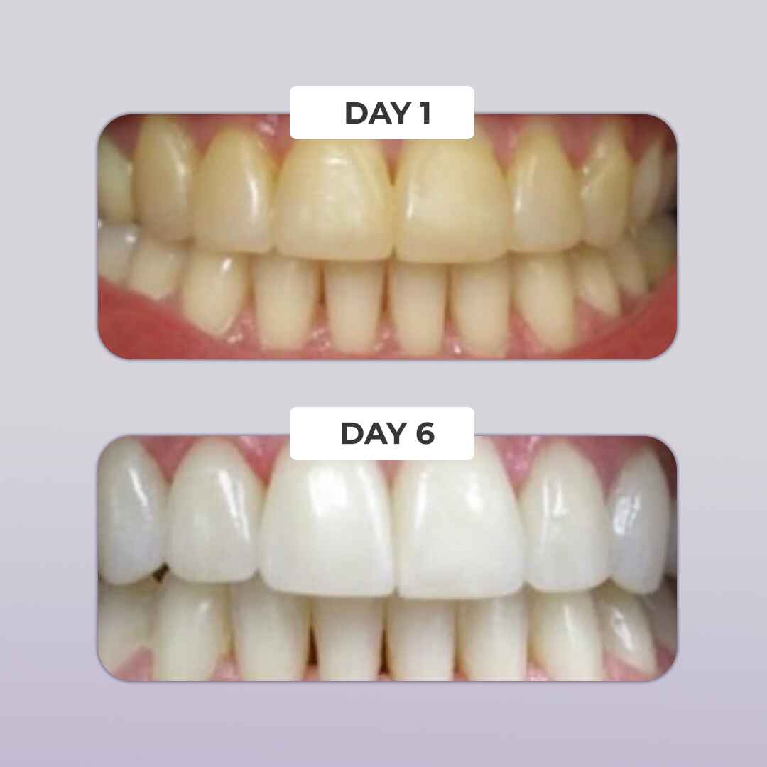 PUURSMILE TEETH WHITENING KIT - 60% OFF HALLOWEEN SALE