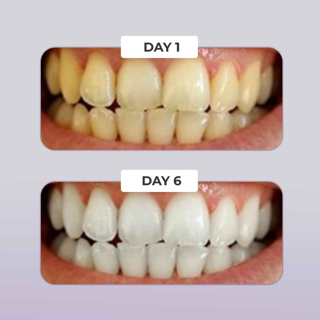 PUURSMILE TEETH WHITENING KIT - 60% OFF HALLOWEEN SALE