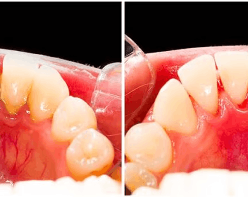 4. Stops Gum Bleeding in Days